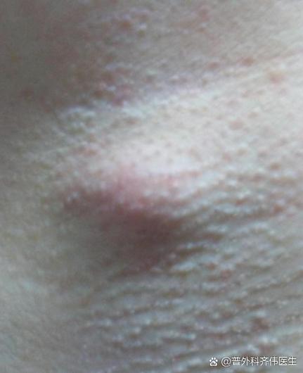 皮肤白色凸起疙瘩是啥病?