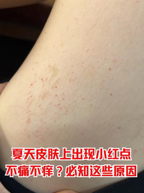 皮肤起小红点不痛不痒是何原因？