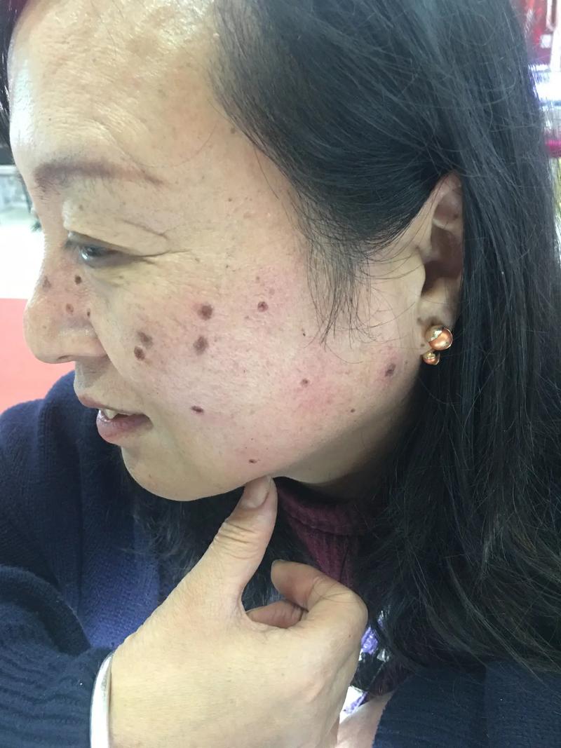 南京皮肤病研究所点痣