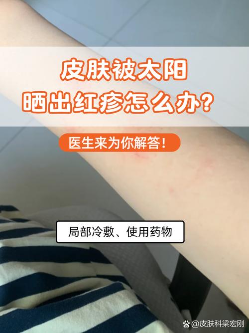 皮肤一晒就红是过敏还是缺保护？